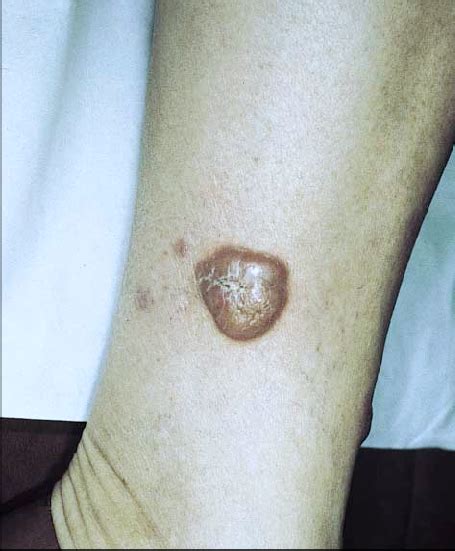 Primary Cutaneous Large B Cell Lymphoma Of The Left Leg Violaceous