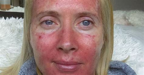 Mum Told Lesions On Her Forehead Were Psoriasis But Doctors Later