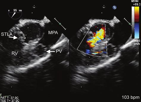 Midesophageal Right Ventricle Inflow Outflow View In A Tetralogy Of
