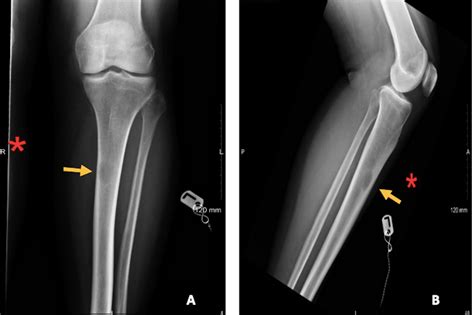 Tibia Fibula Ultrasound My XXX Hot Girl