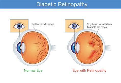 Causes And Treatments For Diabetic Retinopathy Queens Ny