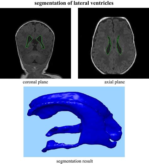 Lateral Ventricular Size In Extremely Premature Infants 3d Mri