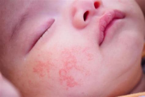 Dermatite Atopica Ed Eczema Quali Sono I Sintomi E Le Cause Nei The