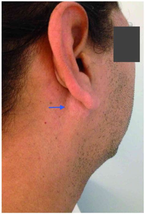 Primary Extraosseous Plasmacytoma Of The Parotid Gland A Case Report