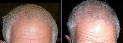 But with a vitamin d deficiency, hair loss can occur for a few reasons. Vitamin D reduces hair loss | VitaminDWiki