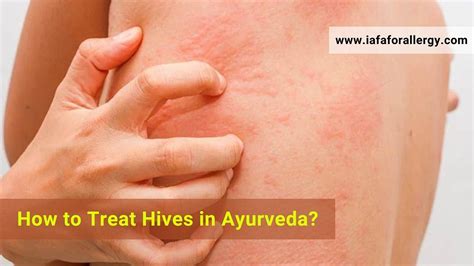 How To Treat Hives In Ayurveda
