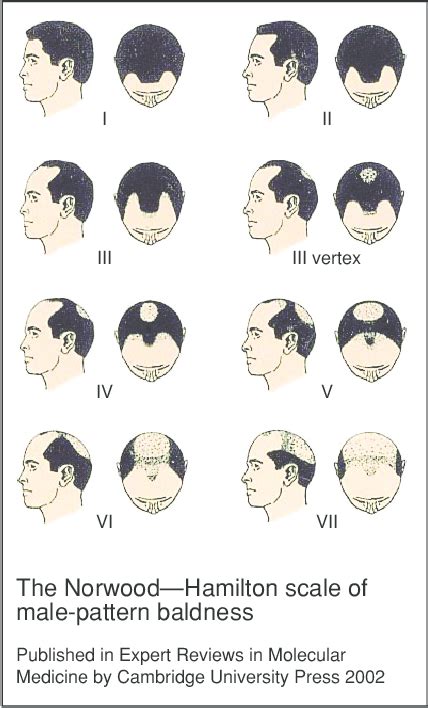 Balding Understanding The Stages Of Hair Loss Ask The Nurse Expert