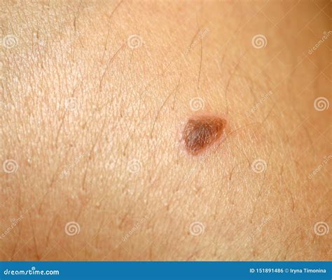 Burn On The Skin Blister On The Skin Stock Photo Image Of Epidermis
