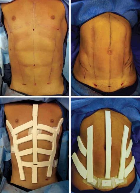 abdominal etching for six pack abs is a thing