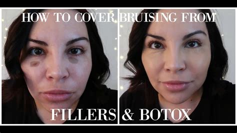 How To Cover Bruising From Fillers And Botox Youtube