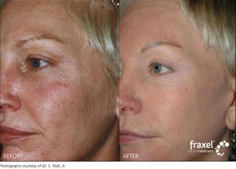Fraxel Restore Laser Skin Rejuvenation Royal Tunbridge Wells Kent Uk