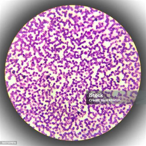 Human Blood Smear View In Microscopy Complete Blood Count For Treatment