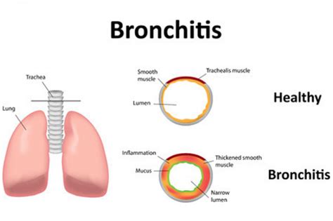 Acute Bronchitis Health Navigator Nz