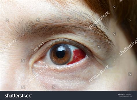Woman Burst Blood Vessel Eye Closeup Stock Photo 1158853312 Shutterstock