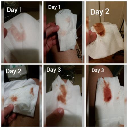Implantation Bleeding Tmi Photo Page Babycenter