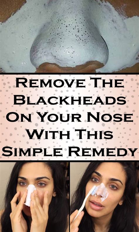 Remove The Blackheads On Your Nose With This Simple Remedy Blackheads