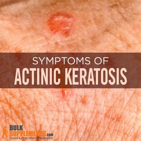 What Is Actinic Keratosis Symptoms Causes Treatment