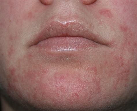 Itchy Face Rash Pictures Photos