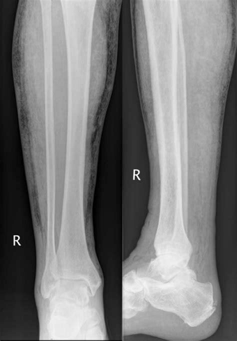Lower Extremity X Ray