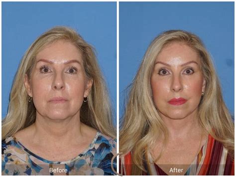 facelift fifties before and after photos patient 79 dr kevin sadati