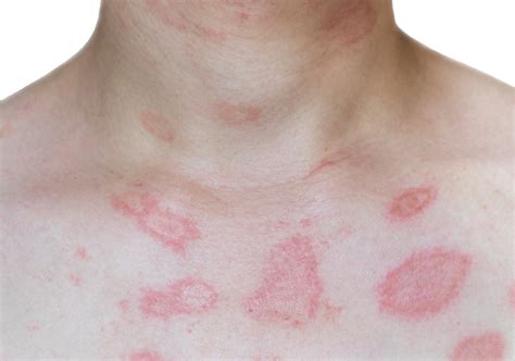 Skin Rashes When To See A Dermatologist Goodless Dermatology