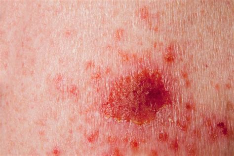 Squamous Cell Carcinoma Prevention Symptoms Diagnosis Overview And
