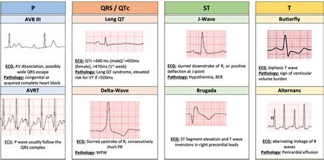 Ekg Pediatric Arrhythmias