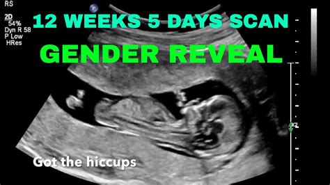 Weeks Days Ultrasound Gender Hot Sex Picture
