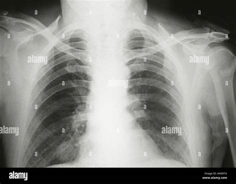 A Chest X Ray Of A Patient With Lung Cancer Showing A Shadow On The