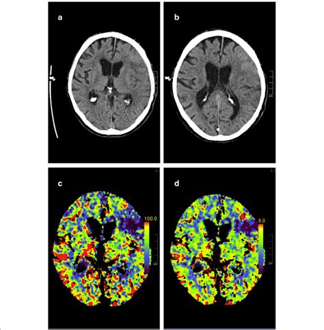 Non Contrast Ct At Admission Showing Left Sided Mca Infarction A B
