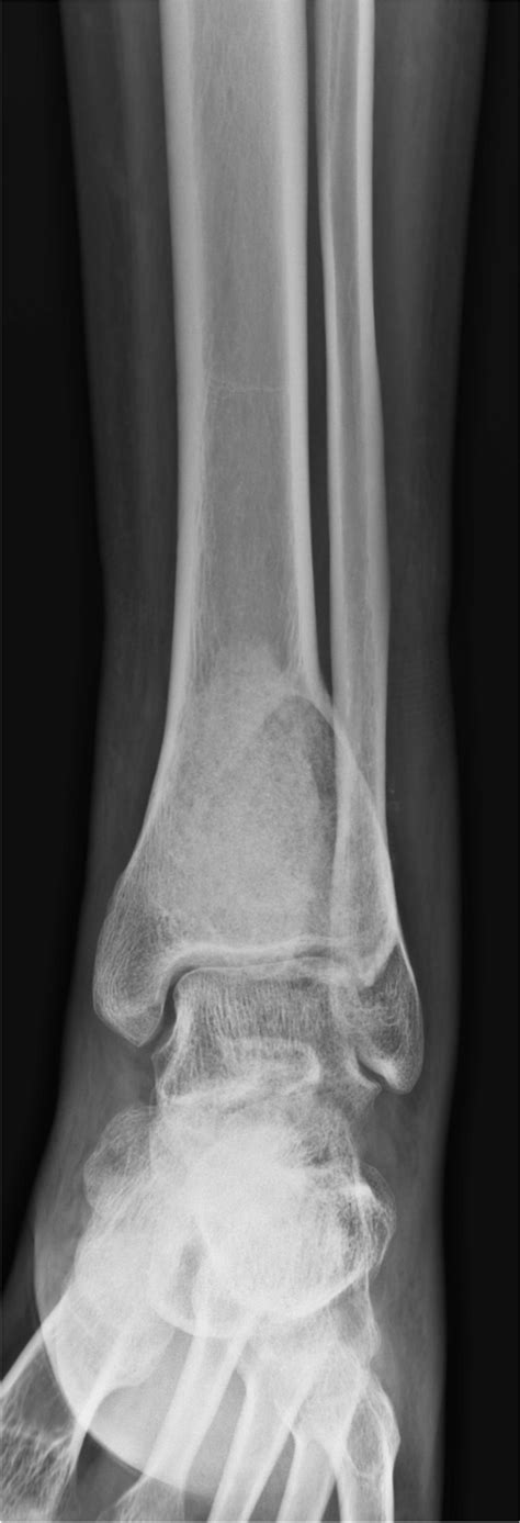 Radiography After Filling Allograft Chip Bone Following Curettage