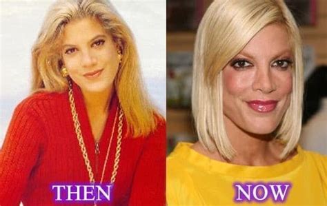 Before And After Plastic Surgery Tori Spelling