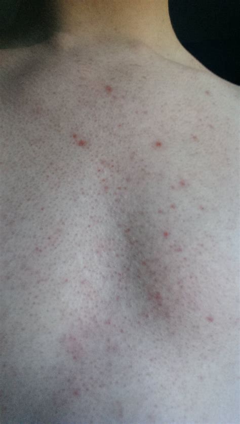M21 Blocked Pores On Chest And Back How To Unblock Acne