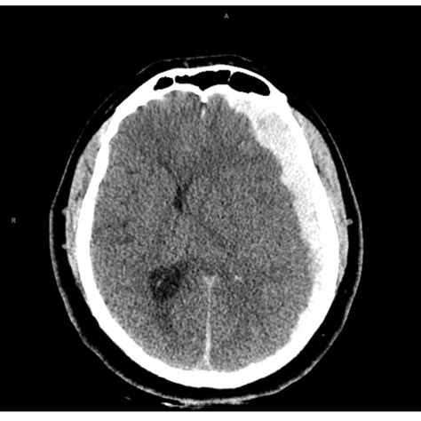Computed Tomography Head Showed An Acute Left Subdural Hemorrhage