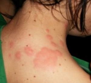 Then you're probably imported to in learning where do bed bugs bite and much as frequently asked the dog or cat owner may truly suspect a flea or mosquito bit the pet. Termite Mound: Will Termites Bite Humans