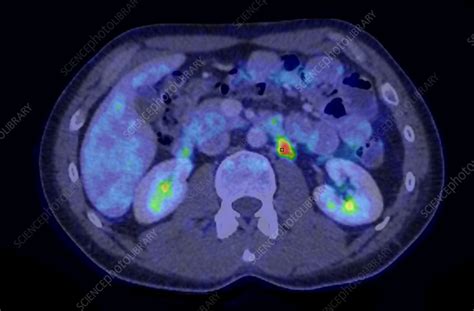 Secondary Lymph Node Cancer Combined Ct And Pet Scans Stock Image
