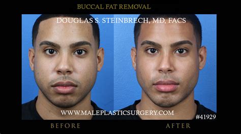 Buccal Fat Removal For Chicago Men Aesthetic Choice