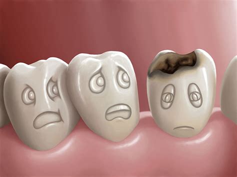 How To Prevent Teeth Decay And Tooth Damage Dental Sanctuary
