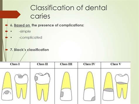 Classification Of Dental Caries Classification Of Dental Caries Porn