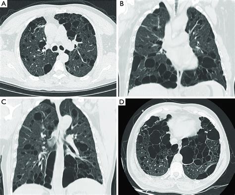 Chest Computed Tomography Ct Of Case A A Axial Ct Shows Pulmonary Download Scientific