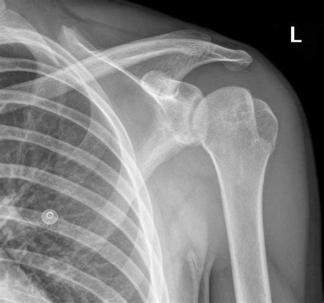 A Hill-Sachs lesion usually results from recurrent ...
