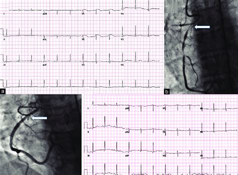 Panel A Electrocardiogram Demonstrating St Elevation Suggestive Of