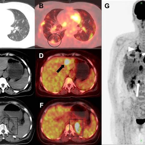 The 18 F Fdg Petct Scans Of The Patient Notes A And B Axial Ct