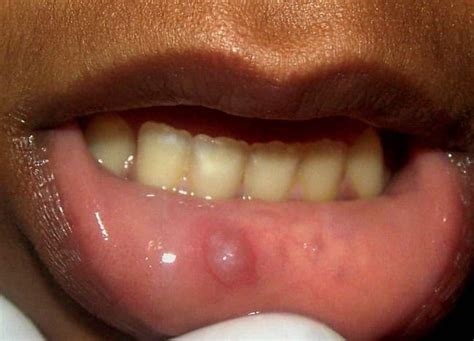 Pictures Causes Symptoms And Treatment Of Oral Mucocele Hubpages