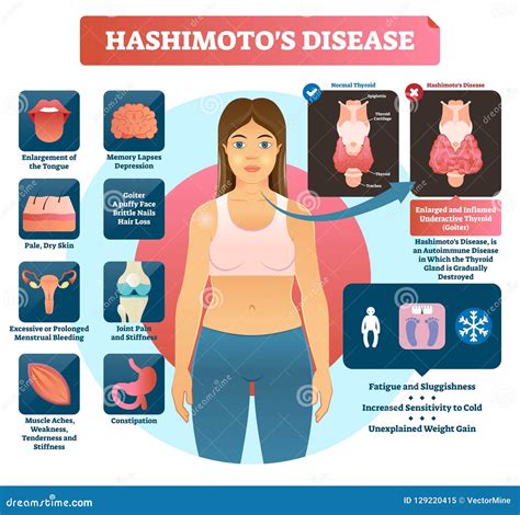 Hashimotos Thyroiditis Vector Illustration Labeled Medical Diagram
