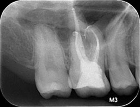 Root canal failures might happen when there are issues with 2 main steps of a root canal treatment. Failure of Root Canal Treatment Misdiagnosed as ...