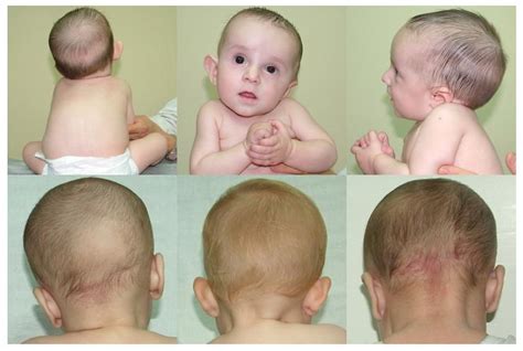 Plagiocephaly Treatment In Adults And Infants With Pictures