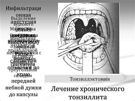 Лечение тонзиллита как вылечить тонзиллит быстро и эффективно