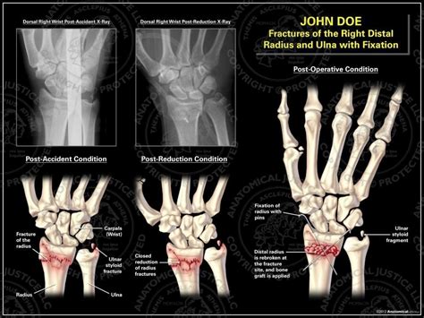 Fractures Of The Right Wrist With Reduction And Fusion Revision