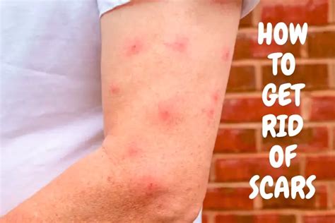 How To Get Rid Of Mosquitoes Scars 7 Powerful Tips